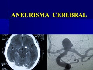 ANEURISMA CEREBRAL
 
