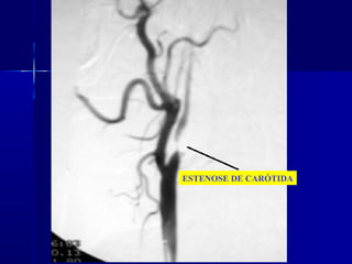 ESTENOSE DE CARÓTIDA
 