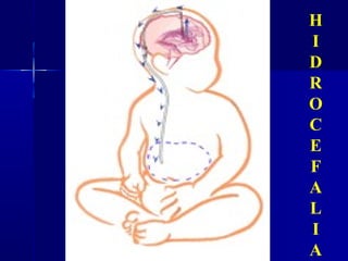 H
I
D
R
O
C
E
F
A
L
I
A
 