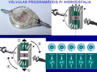VÁLVULAS PROGRAMÁVEIS P/ HIDROCEFALIA
 