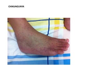 CHIKUNGUNYA
 
