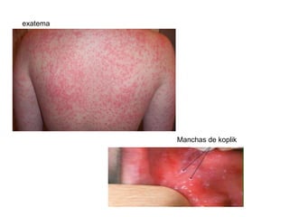 exatema
Manchas de koplik
 
