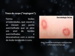 Tinea do corpo ("impingem"): Forma lesões arredondadas, que coçam e se iniciam por ponto avermelhado que se abre em anel de bordas avermelhadas e descamativas com o centro da lesão tendendo à cura. http://www.dermatologia.net/novo/base/fotos/tineacorpo.jpg 