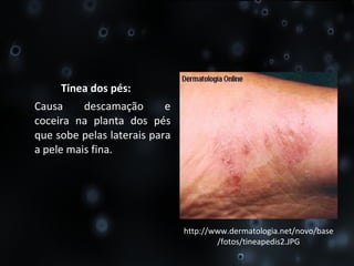 Tinea dos pés: Causa descamação e coceira na planta dos pés que sobe pelas laterais para a pele mais fina. http://www.dermatologia.net/novo/base/fotos/tineapedis2.JPG 