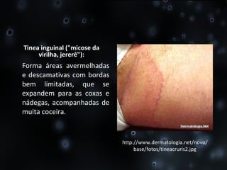 Tinea inguinal ("micose da virilha, jererê"): Forma áreas avermelhadas e descamativas com bordas bem limitadas, que se expandem para as coxas e nádegas, acompanhadas de muita coceira. http://www.dermatologia.net/novo/base/fotos/tineacruris2.jpg 