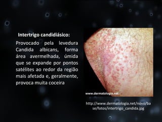 Intertrigo candidiásico: Provocado pela levedura Candida albicans, forma área avermelhada, úmida que se expande por pontos satélites ao redor da região mais afetada e, geralmente, provoca muita coceira http://www.dermatologia.net/novo/base/fotos/intertrigo_candida.jpg 
