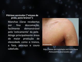 Pitiríase versicolor ("micose de praia, pano branco"): Manchas claras recobertas por fina descamação, facilmente demonstrável pelo ‘esticamento’ da pele.  Atinge principalmente áreas de maior produção de oleosidade como o tronco, a face, pescoço e couro cabeludo. http://www.dermatologia.net/novo/base/fotos/pitiriaseversicolor.jpg 