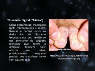 Tinea interdigital ("frieira"): Causa descamação, maceração (pele esbranquiçada e mole), fissuras e coceira entre os dedos dos pés.  Bastante frequente nos pés, devido ao uso constante de calçados fechados que retém a umidade, também pode ocorrer nas mãos, principalmente naquelas pessoas que trabalham muito com água e sabão http://www.dermatologia.net/novo/base/fotos/intertrigo.jpg 