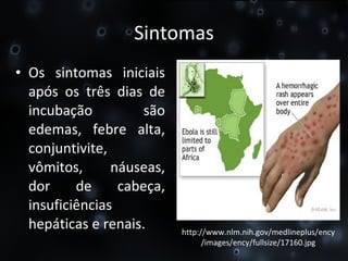Sintomas Os sintomas iniciais após os três dias de incubação são edemas, febre alta, conjuntivite, vômitos, náuseas, dor de cabeça, insuficiências hepáticas e renais. http://www.nlm.nih.gov/medlineplus/ency/images/ency/fullsize/17160.jpg 
