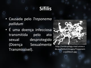 Sífilis Causada pelo  Treponema pallidum É uma doença infecciosa transmitida pelo ato sexual desprotegido (Doença Sexualmente Transmissível). http://embryology.med.unsw.edu.au/Defect/images/Treponema-pallidum.jpg 