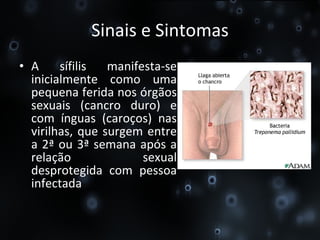 Sinais e Sintomas A sífilis manifesta-se inicialmente como uma pequena ferida nos órgãos sexuais (cancro duro) e com ínguas (caroços) nas virilhas, que surgem entre a 2ª ou 3ª semana após a relação sexual desprotegida com pessoa infectada 
