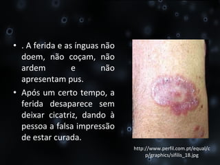 . A ferida e as ínguas não doem, não coçam, não ardem e não apresentam pus. Após um certo tempo, a ferida desaparece sem deixar cicatriz, dando à pessoa a falsa impressão de estar curada. http://www.perfil.com.pt/equal/cp/graphics/sifilis_18.jpg 