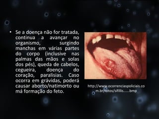 Se a doença não for tratada, continua a avançar no organismo, surgindo manchas em várias partes do corpo (inclusive nas palmas das mãos e solas dos pés), queda de cabelos, cegueira, doença do coração, paralisias. Caso ocorra em grávidas, poderá causar aborto/natimorto ou má formação do feto.  http://www.ocorrenciaspoliciais.com.br/fotos/sifillis......bmp 