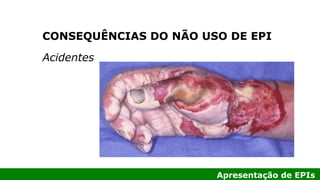 Apresentação de EPIs
Acidentes
CONSEQUÊNCIAS DO NÃO USO DE EPI
 