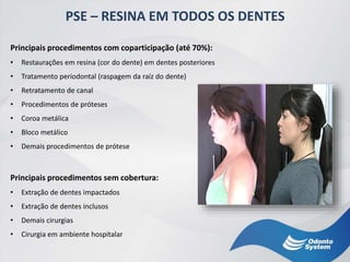 PSE – RESINA EM TODOS OS DENTES
Principais procedimentos com coparticipação (até 70%):
• Restaurações em resina (cor do dente) em dentes posteriores
• Tratamento periodontal (raspagem da raíz do dente)
• Retratamento de canal
• Procedimentos de próteses
• Coroa metálica
• Bloco metálico
• Demais procedimentos de prótese
Principais procedimentos sem cobertura:
• Extração de dentes impactados
• Extração de dentes inclusos
• Demais cirurgias
• Cirurgia em ambiente hospitalar
 