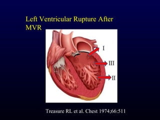 Left Ventricular Rupture After
MVR




      Treasure RL et al. Chest 1974;66:511
 