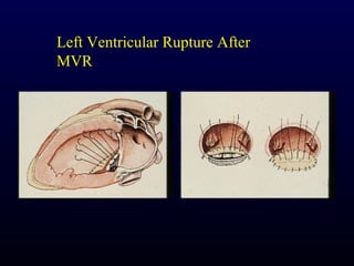 Left Ventricular Rupture After
MVR
 