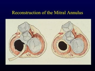Reconstruction of the Mitral Annulus
 