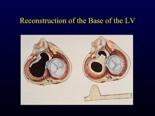 Reconstruction of the Base of the LV
 