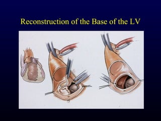 Reconstruction of the Base of the LV
 