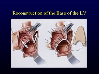 Reconstruction of the Base of the LV
 