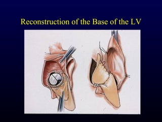 Reconstruction of the Base of the LV
 