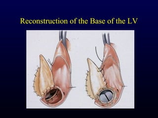 Reconstruction of the Base of the LV
 