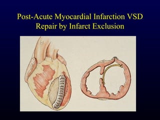 Post-Acute Myocardial Infarction VSD
     Repair by Infarct Exclusion
 