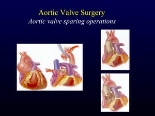 Aortic Valve Surgery
Aortic valve sparing operations
 