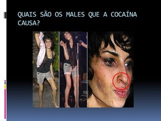 QUAIS SÃO OS MALES QUE A COCAÍNA
CAUSA?
 