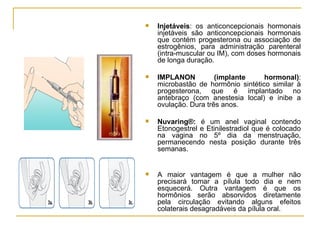 Injetáveis : os anticoncepcionais hormonais injetáveis são anticoncepcionais hormonais que contém progesterona ou associação de estrogênios, para administração parenteral (intra-muscular ou IM), com doses hormonais de longa duração.  IMPLANON (implante hormonal) : microbastão de hormônio sintético similar à progesterona, que é implantado no antebraço (com anestesia local) e inibe a ovulação. Dura três anos. Nuvaring®:  é um anel vaginal contendo Etonogestrel e Etinilestradiol que é colocado na vagina no 5º dia da menstruação, permanecendo nesta posição durante três semanas. A maior vantagem é que a mulher não precisará tomar a pílula todo dia e nem esquecerá. Outra vantagem é que os hormônios serão absorvidos diretamente pela circulação evitando alguns efeitos colaterais desagradáveis da pílula oral. 
