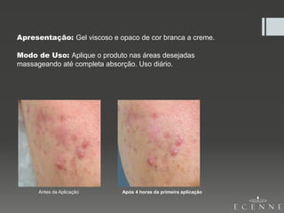 Apresentação: Gel viscoso e opaco de cor branca a creme.
Modo de Uso: Aplique o produto nas áreas desejadas
massageando até completa absorção. Uso diário.
Antes da Aplicação Após 4 horas da primeira aplicação
 