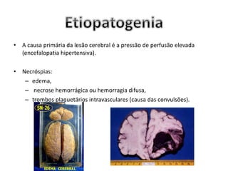 •   A causa primária da lesão cerebral é a pressão de perfusão elevada
    (encefalopatia hipertensiva).

•   Necróspias:
     – edema,
     – necrose hemorrágica ou hemorragia difusa,
     – trombos plaquetários intravasculares (causa das convulsões).
 