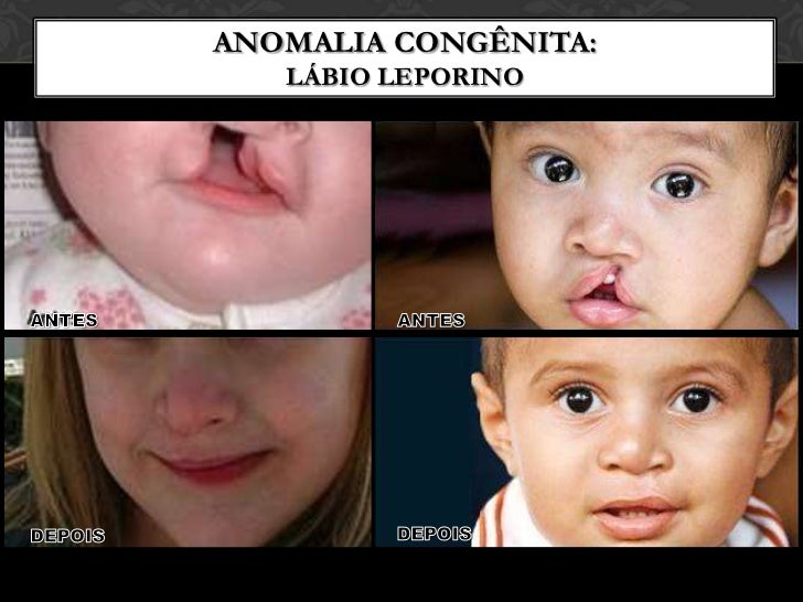 Labios Rombicos Embriologia da Face