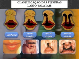 Desenvolvimento da Face  Anomalias na formação da face: período de maior risco