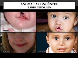 Classificação das fissurasLabio-Palatais