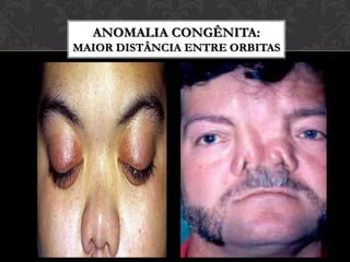 ANOMALIA CONGÊNITA:LÁBIO LEPORINOANTESANTESDEPOISDEPOIS