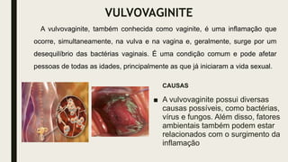 VULVOVAGINITE
CAUSAS
■ A vulvovaginite possui diversas
causas possíveis, como bactérias,
vírus e fungos. Além disso, fatores
ambientais também podem estar
relacionados com o surgimento da
inflamação
A vulvovaginite, também conhecida como vaginite, é uma inflamação que
ocorre, simultaneamente, na vulva e na vagina e, geralmente, surge por um
desequilíbrio das bactérias vaginais. É uma condição comum e pode afetar
pessoas de todas as idades, principalmente as que já iniciaram a vida sexual.
 