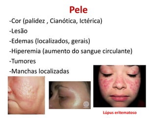 Pele
-Cor (palidez , Cianótica, Ictérica)
-Lesão
-Edemas (localizados, gerais)
-Hiperemia (aumento do sangue circulante)
-Tumores
-Manchas localizadas
Lúpus eritematoso
 