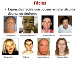 Fácies
• Expressões faciais que podem remeter alguma
doença ou síndrome.
Cushingóide Renal ou Nefrótica Paralisia facial Parkinsoniana
Downiana Tetânica Leonina(lepra) Hipertireóidea
 