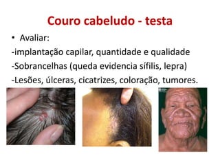 Couro cabeludo - testa
• Avaliar:
-implantação capilar, quantidade e qualidade
-Sobrancelhas (queda evidencia sífilis, lepra)
-Lesões, úlceras, cicatrizes, coloração, tumores.
 