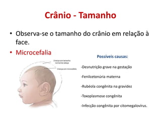 Crânio - Tamanho
• Observa-se o tamanho do crânio em relação à
face.
• Microcefalia Possíveis causas:
-Desnutrição grave na gestação
-Fenilcetonúria materna
-Rubéola congênita na gravidez
-Toxoplasmose congênita
-Infecção congênita por citomegalovírus.
 
