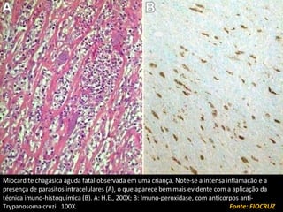 Infecção pelo Parasita Reprodução nos Tecidos Musculares Parasitemia Resposta Imune Destruição celular Miocardite chagásica aguda fatal observada em uma criança. Note-se a intensa inflamação e a presença de parasitos intracelulares (A), o que aparece bem mais evidente com a aplicação da técnica imuno-histoquímica (B). A: H.E., 200X; B: Imuno-peroxidase, com anticorpos anti-Trypanosoma cruzi.  100X .  Fonte: FIOCRUZ 