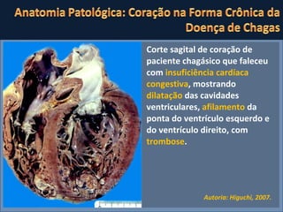 Corte sagital de coração de paciente chagásico que faleceu com  insuficiência cardíaca congestiva , mostrando  dilatação  das cavidades ventriculares,  afilamento  da ponta do ventrículo esquerdo e do ventrículo direito, com  trombose .  Autoria: Higuchi, 2007. 