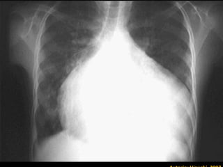 Afilamento do miocárdio da região póstero – lateral e basal do Ventrículo Esquerdo, com substituição por fibrose. Freqüente foco de arritmia cardíaca tipo taquicardia ventricular sustentada.  Autoria: Higuchi, 2007. Típica lesão apical “aneurismática” da forma crônica cardíaca da doença de Chagas Imagem: FIOCRUZ Autoria: Higuchi, 2007 