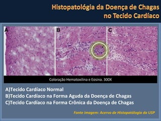 Coloração Hematoxilina e Eosina. 300X A)Tecido Cardíaco Normal B)Tecido Cardíaco na Forma Aguda da Doença de Chagas C)Tecido Cardíaco na Forma Crônica da Doença de Chagas Fonte imagem: Acervo de Histopatólogia da USP  