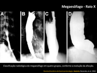 Megaesôfago - Raio X   Classificação radiológica do megaesôfago em quatro grupos, conforme a evolução da afecção. Revista Brasileira de Gastroenterologia.  Autoria:   Rezende, et al, 1960 . 