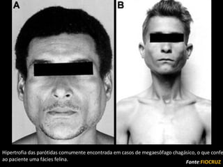 Hipertrofia das parótidas comumente encontrada em casos de megaesôfago chagásico, o que confere ao paciente uma fácies felina. Fonte : FIOCRUZ 