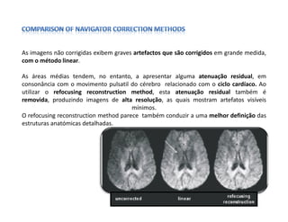 As imagens não corrigidas exibem graves artefactos que são corrigidos em grande medida,
com o método linear.

As áreas médias tendem, no entanto, a apresentar alguma atenuação residual, em
consonância com o movimento pulsatil do cérebro relacionado com o ciclo cardíaco. Ao
utilizar o refocusing reconstruction method, esta atenuação residual também é
removida, produzindo imagens de alta resolução, as quais mostram artefatos visíveis
                                       mínimos.
O refocusing reconstruction method parece também conduzir a uma melhor definição das
estruturas anatómicas detalhadas.
 
