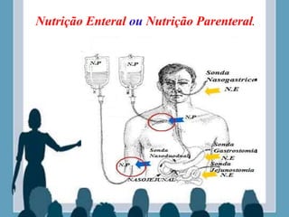 Nutrição Enteral ou Nutrição Parenteral.
 